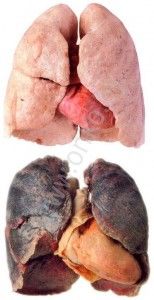 Здоровое и больное легкое Здоровое и больное раком легкое