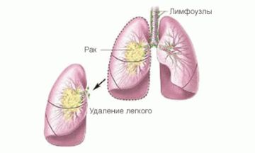 Оперативное вмешательство Удаление левого легкого