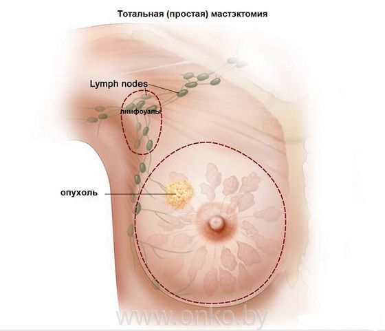 Действительно ли белокочанная капуста помогает в лечении фиброзно-кистозных изменений (мастопатии)?