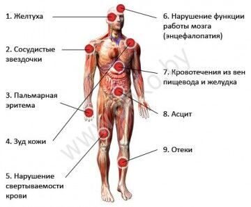 Органы поражаемые циррозом и признаки цирроза