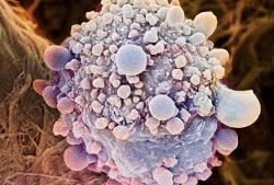 Клетка рака поджелудочной железы под микроскопом