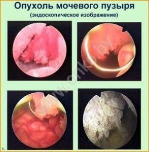 Эндоскопическое изображение рака мочевого пузыря