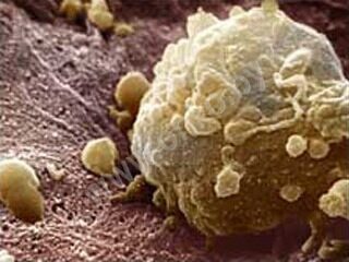 Рак кожи под микроскопом