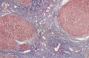 Клетка пораженная циррозом под микроскопом