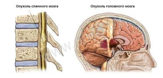 Опухоль головного и спинного мозга