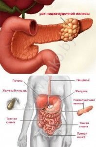 Рак поджелудочной железы, печень, желчный пузырь, пищевод, желудок, поджелудочная железа, тонкая кишка, прямая кишка
