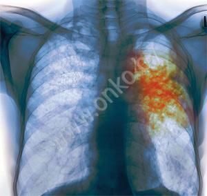 Рентген-снимок туберкулеза легкого