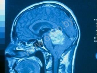 Рентген-снимок рака головного мозга (опухоли мозга)