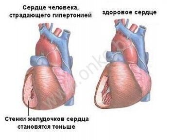 Сердце страдающее гипертонией и здоровое сердце