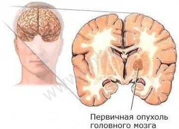 Первичный рак головного мозга (опухоль мозга)