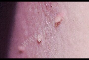 Разновидность рака кожи - папиллярный рак кожи